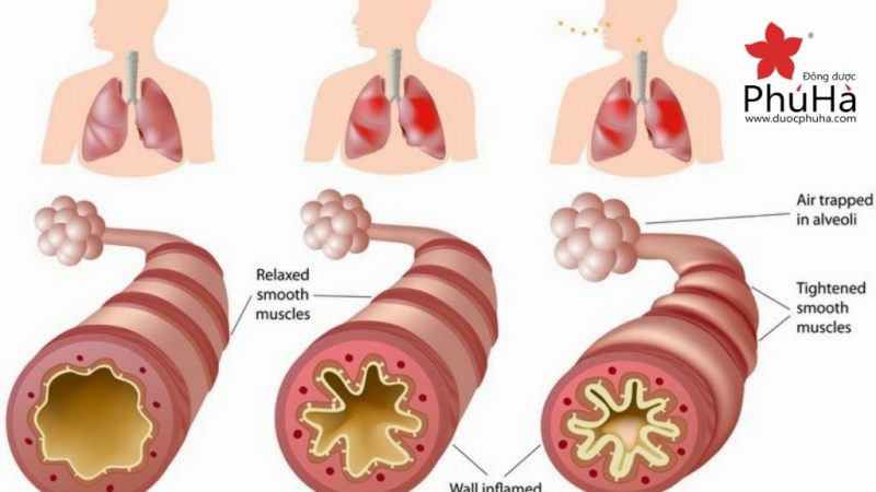 Viêm phế quản mạn tính (mãn tính) – chronic bronchitis