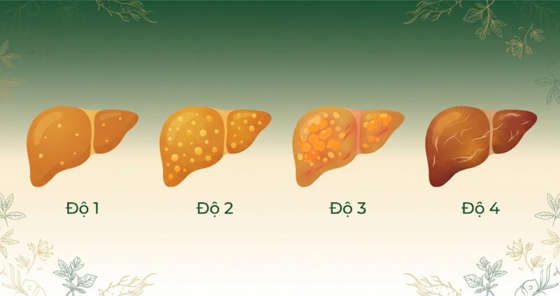 Gan nhiễm mỡ độ 1, 2, 3, 4 — Dấu hiệu nhận biết và cách hỗ trợ cải thiện Gan nhiễm mỡ độ 1, 2, 3, 4 — Dấu hiệu nhận biết và cách hỗ trợ cải thiện